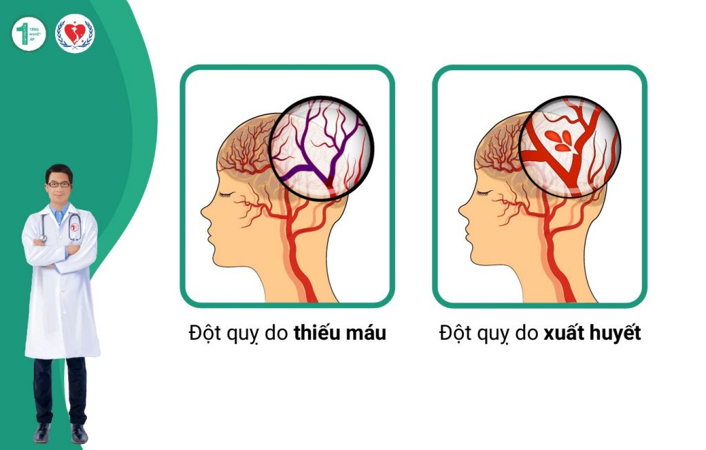 Đột quỵ do thiếu máu và xuất huyết